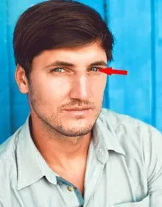 Thickened limbal ring example